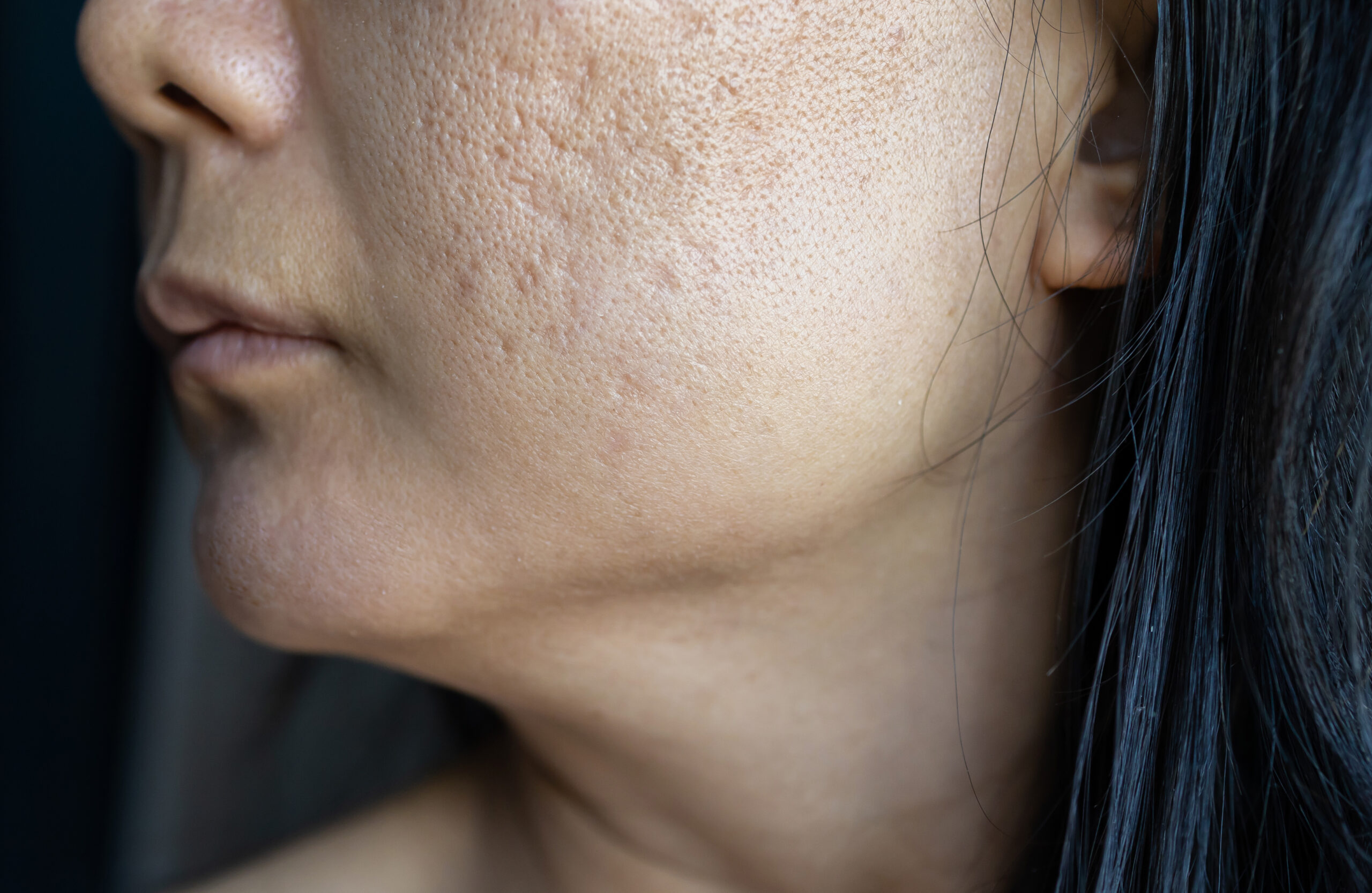 Close-up of a woman’s profile with acne scars and textured skin, perfect for highlighting med spa skin treatments in Hayden, Idaho. at North Idaho Med Spa in Hayden