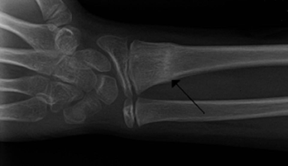 220px Bucklefracture
