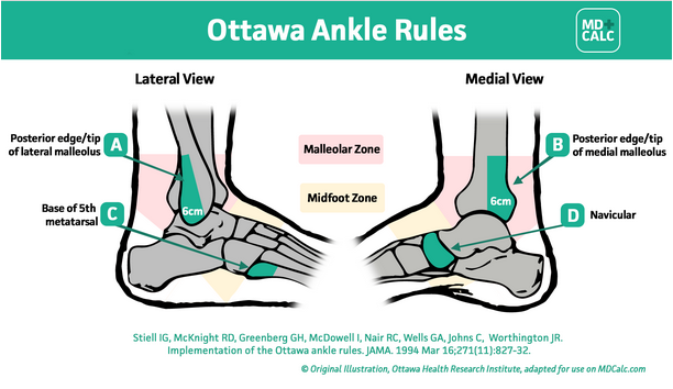 Should you spend $300 to X-Ray your ankle? Ottowa Ankle Rules On MD Calc