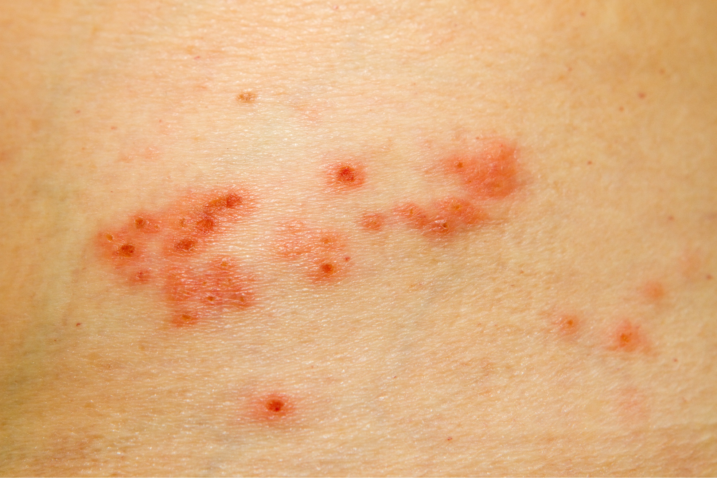 What to do for Shingles Photodune 3921162 Shingles Rash Smol